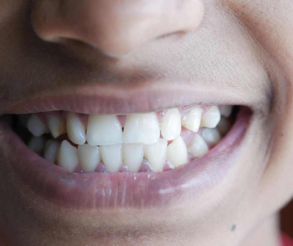 Вініри на криві зуби - чи це можливо?